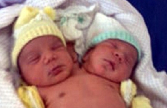 Бебе с две глави се роди в Бразилия