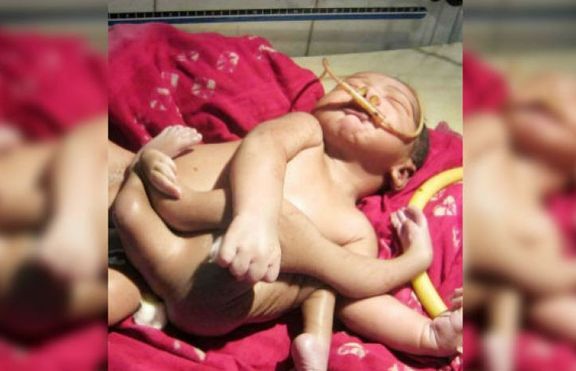 Бебе с четири ръце и четири крака беше обявено за божествено [+ видео]